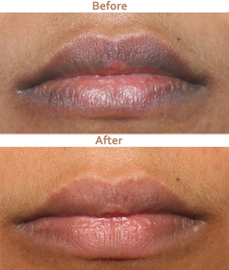 Dark_Lip_laser_Treatment