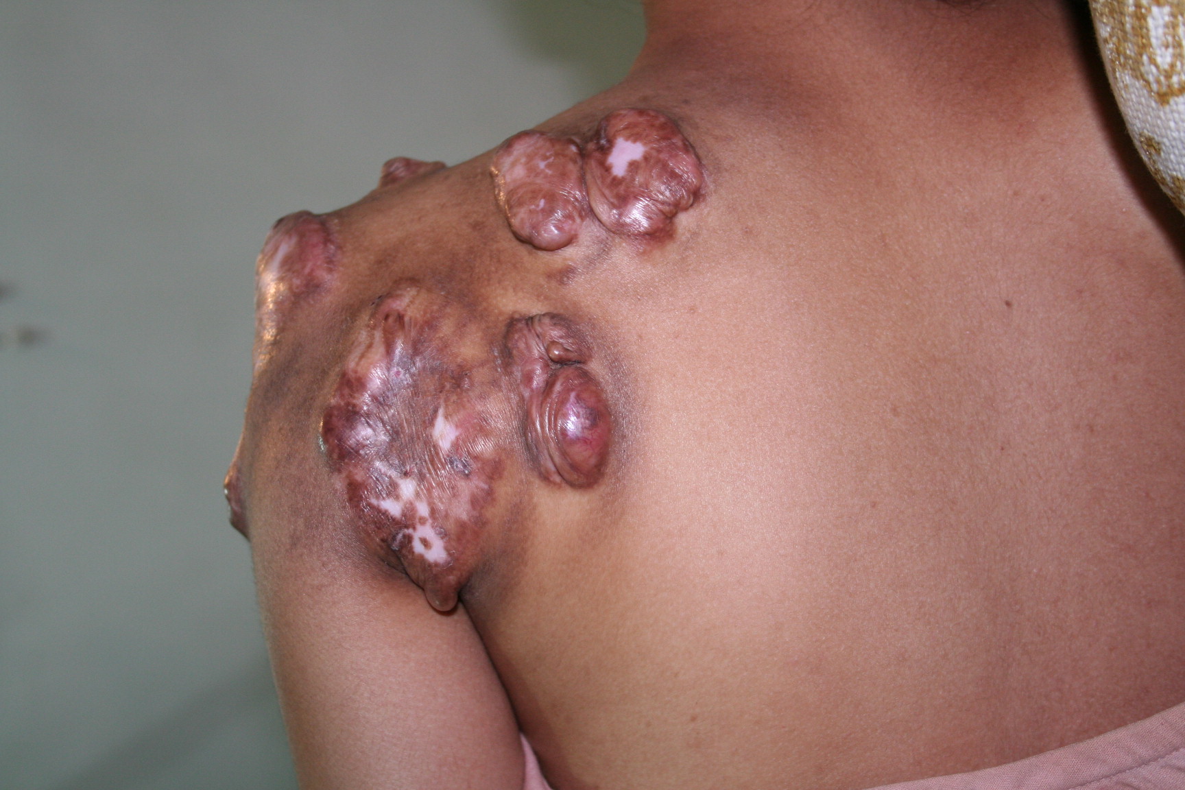 Keloid scarring - Live Well - NHS Choices