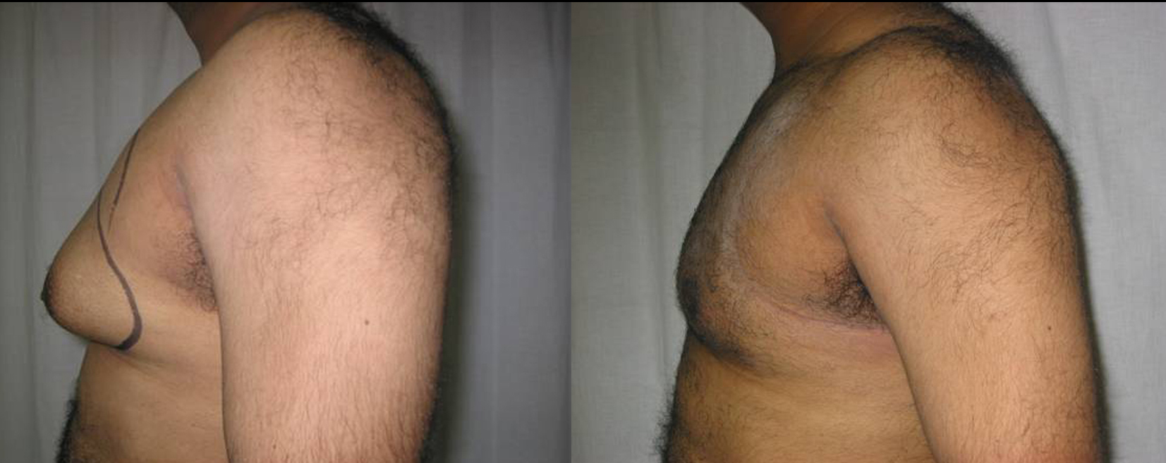 Gynecomastia